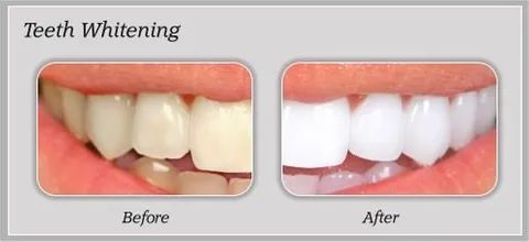 Tooth Whitening Before and After