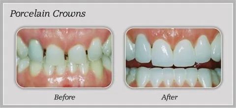 Ceramic Crowns Before and After