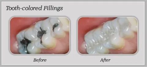 Tooth Colored Fillings Before and After